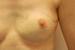 Brustrekonstruktion mit Haut-Muskel-Lappen